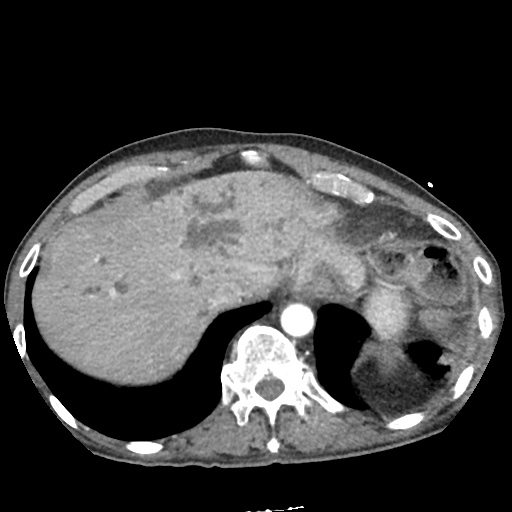 biliary duct dilation icd 10