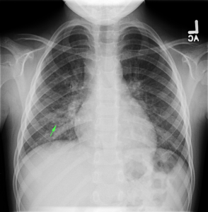 CXR with infiltrates