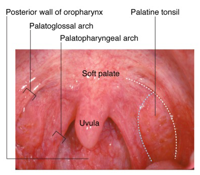 palatoglossal arch redness