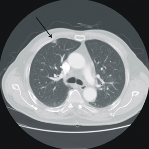 Image from: Maeng, C. H., Chin, S. O., Yang, B. H., Kim, S.-Y., Youn, H.-J., Cho, K. S., Baek, S. K., et al. (2007). A case of organizing pneumonia associated with rituximab. Cancer research and treatment : official journal of Korean Cancer Association, 39(2), 88–91. doi:10.4143/crt.2007.39.2.88