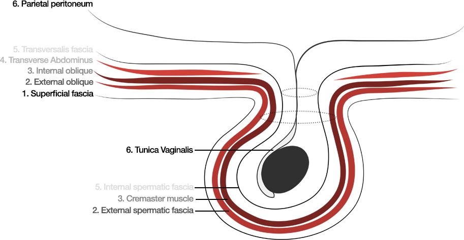 transversalis fascia hernia