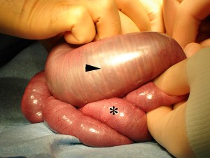 Dilated loops of small bowel