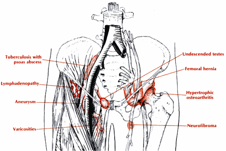 Hernia Tags - Differential Diagnosis of