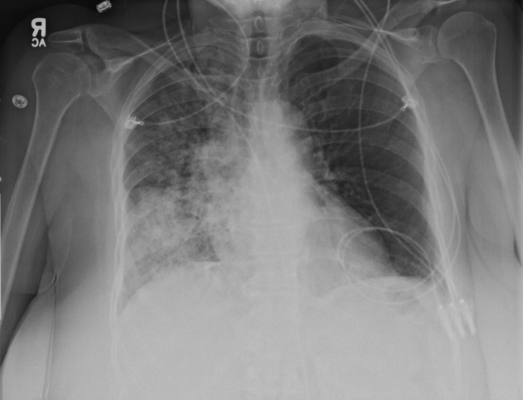 CXR PA