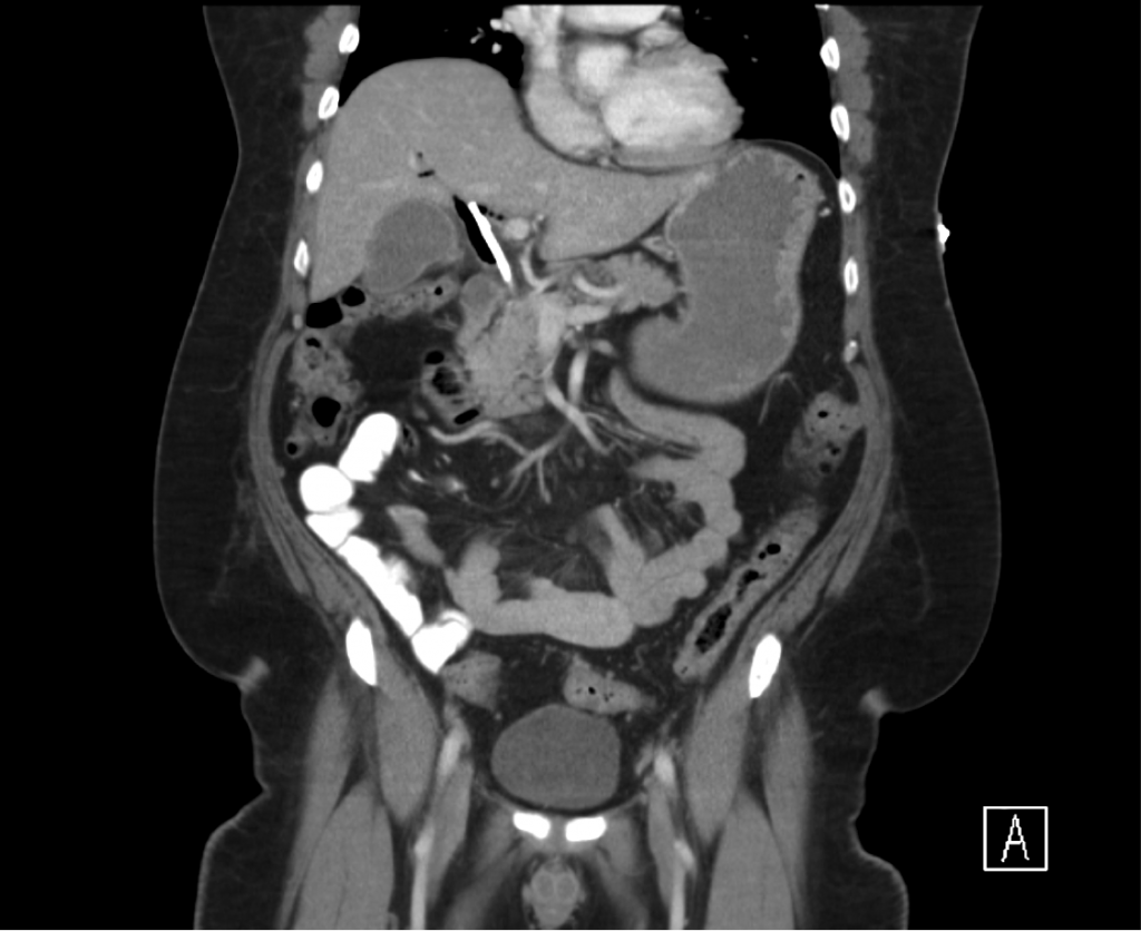 CT Abdomen/Pelvis