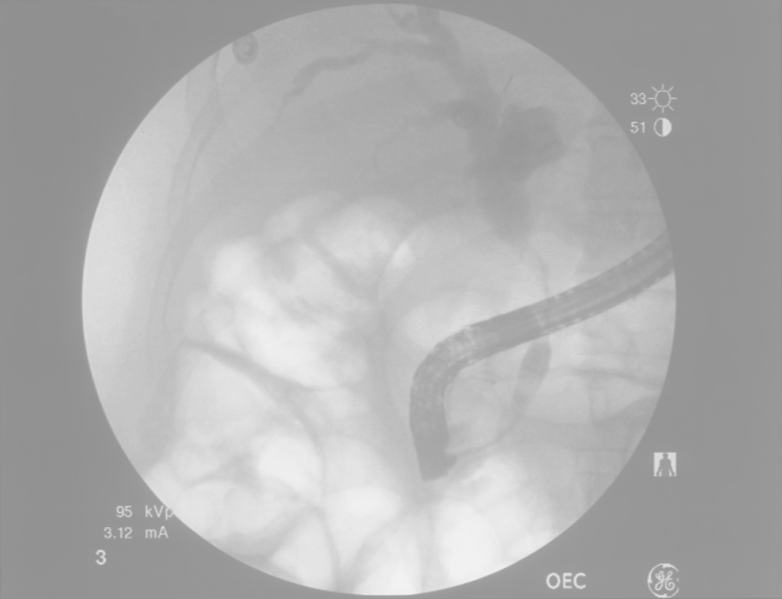 ERCP