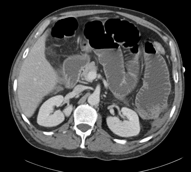 CT abdomen/pelvis