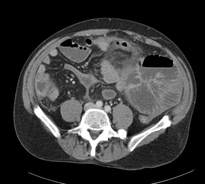 CT abdomen/pelvis