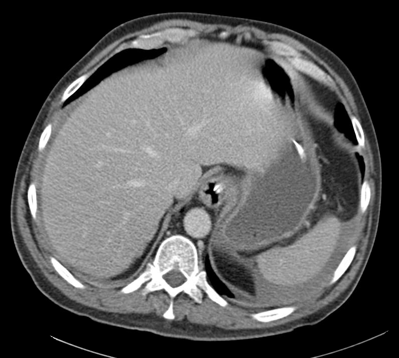 CT abdomen/pelvis