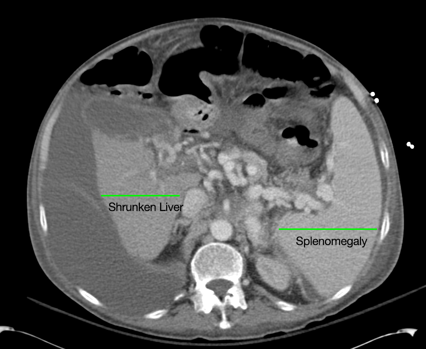 Cirrhosis and Portal Hypertension