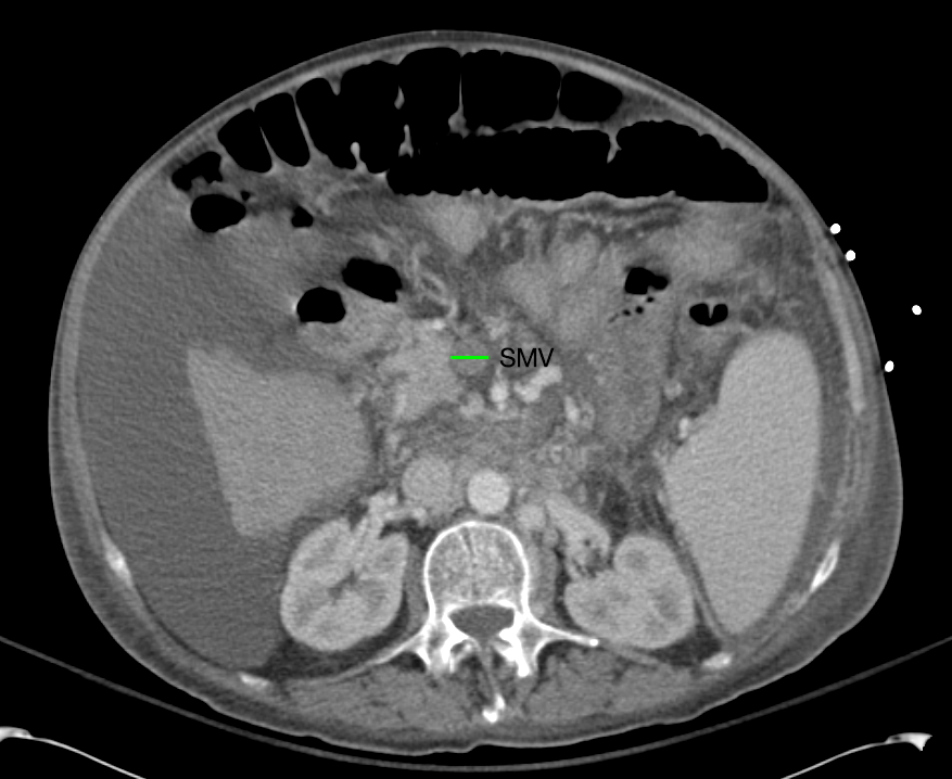 SMV Thrombosis