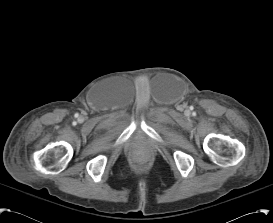 B/L Inguinal Hernias