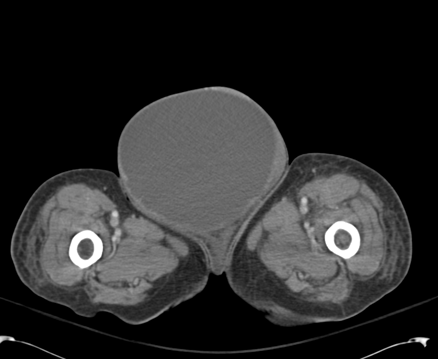 Large Right Inguinal Hernia