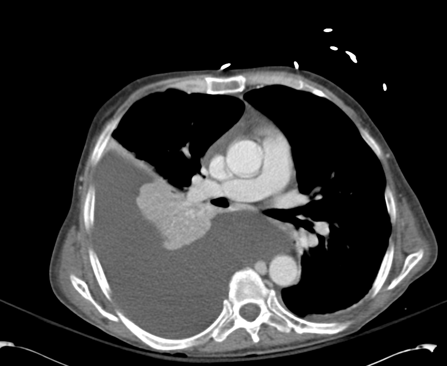 Pleural Effusion