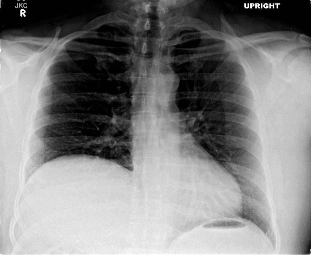 Differential Diagnosis of Elevated Hemidiaphragm