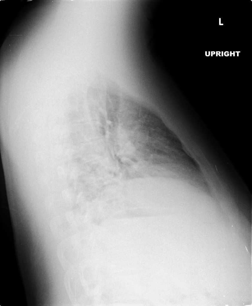 CXR - Lateral