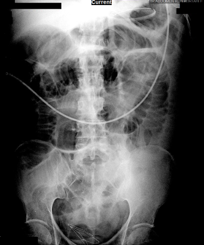 kub - Differential Diagnosis of