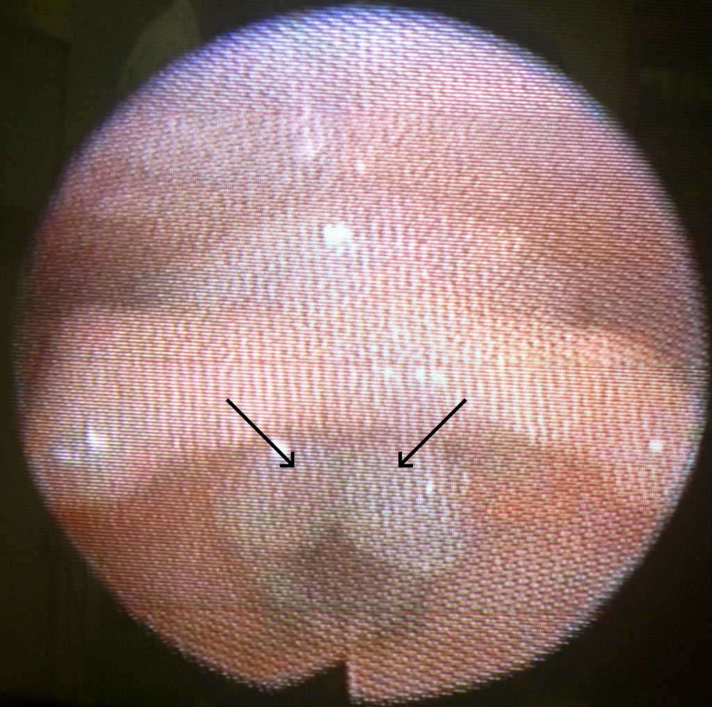 Flexible nasolaryngoscopy image showing trauma granulomata.