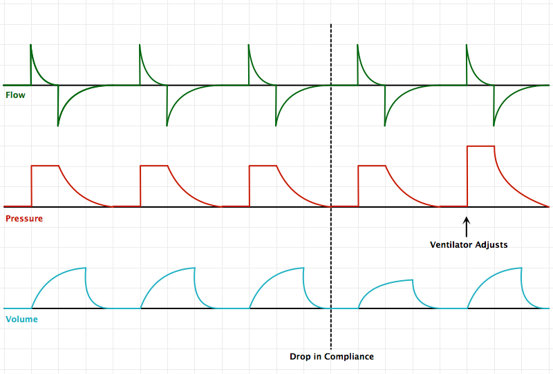 Pressure-Regulated Volume Control (PRVC)