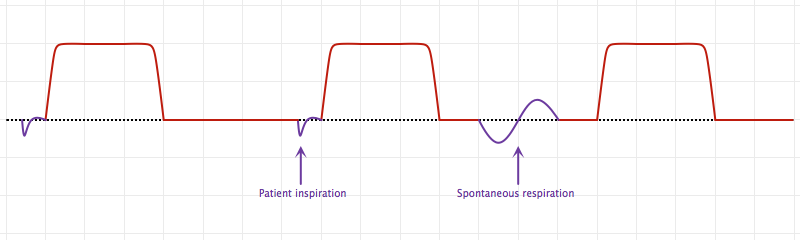 Synchronized Intermittent Mandatory Ventilation (SIMV)