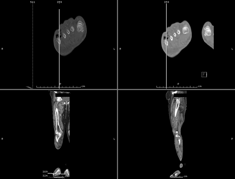 lle necrotizing soft tissue infection icd 10