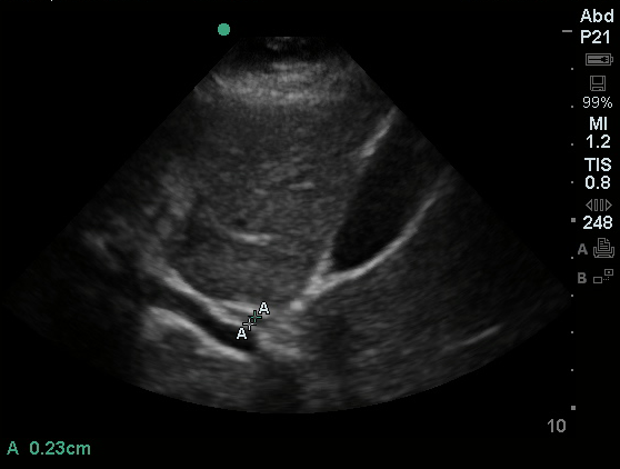 Common Bile Duct - Differential Diagnosis of