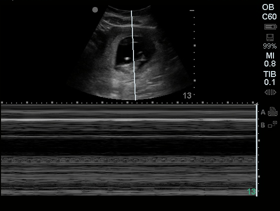 Fetal Heart Rate