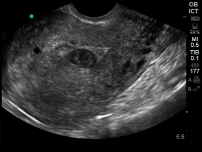 Pseudogestational Sac - Differential Diagnosis of