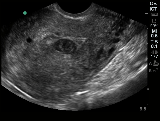 Pseudogestational Sac