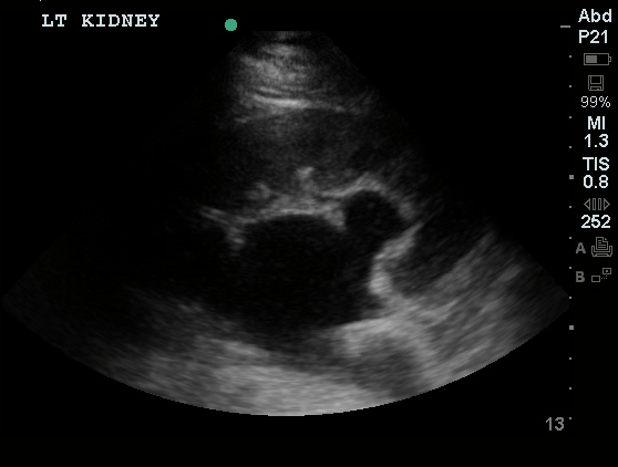 Hydronephrosis