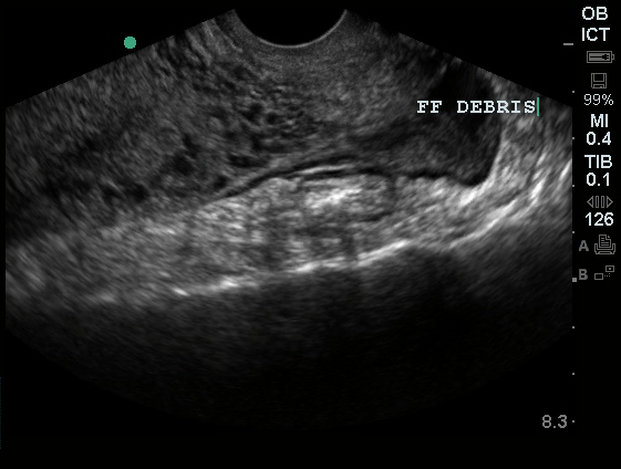 Pelvic Free Fluid