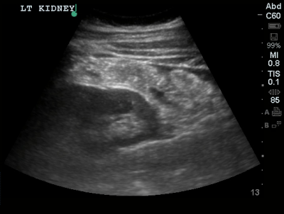 Splenorenal Free Fluid - Differential Diagnosis of