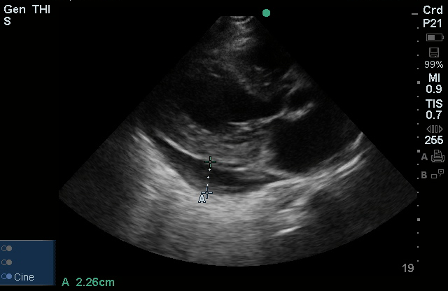 Pericardial Effusion