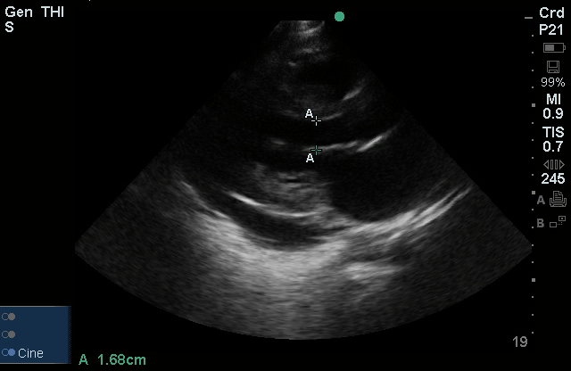 E-Point Septal Separation