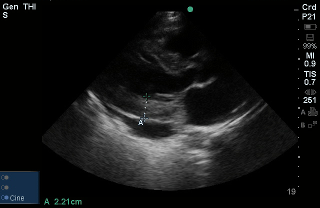 Left Ventricular Hypertrophy