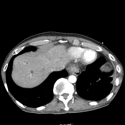 Differential Diagnosis of Biliary Duct Dilation