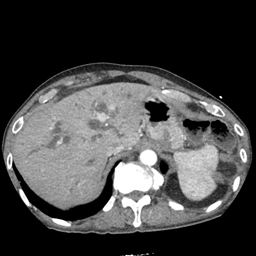 Differential Diagnosis of Biliary Duct Dilation