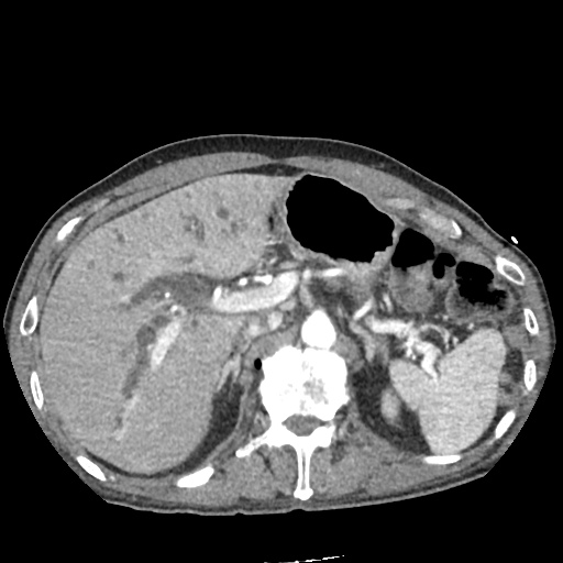 Differential Diagnosis of Biliary Duct Dilation