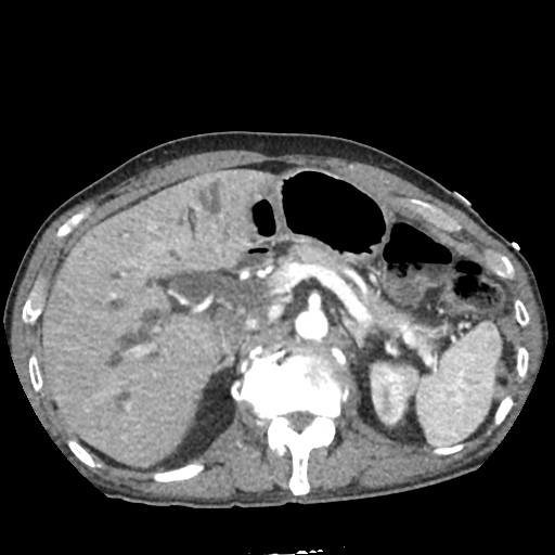 Differential Diagnosis of Biliary Duct Dilation