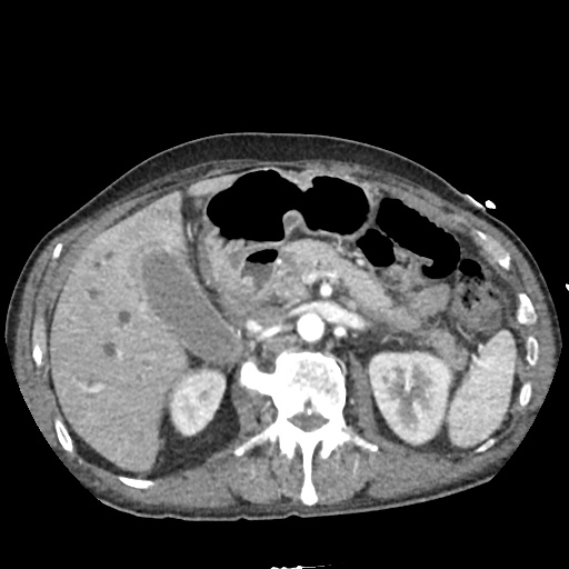 Differential Diagnosis of Biliary Duct Dilation