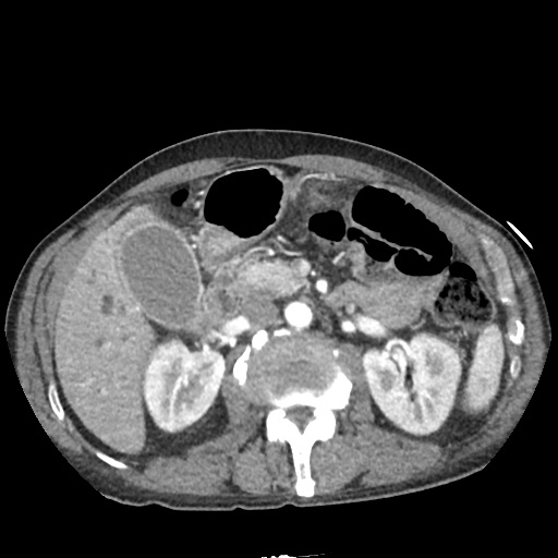 Differential Diagnosis of Biliary Duct Dilation