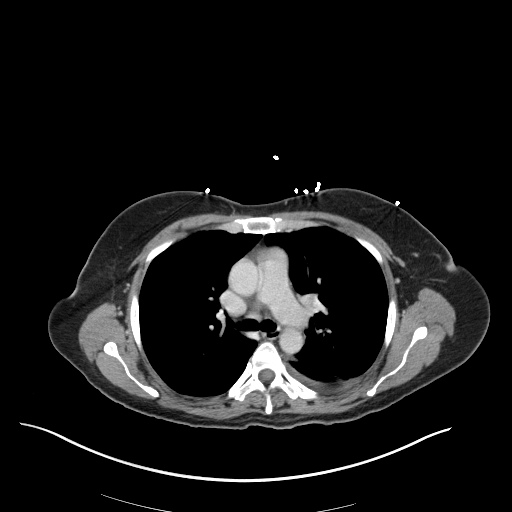 pleural Effusion, Pulmonary Embolism