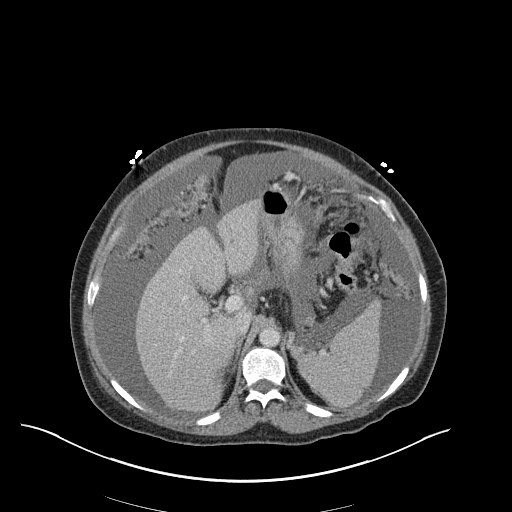 Pleural Effusion, Pulmonary Embolism