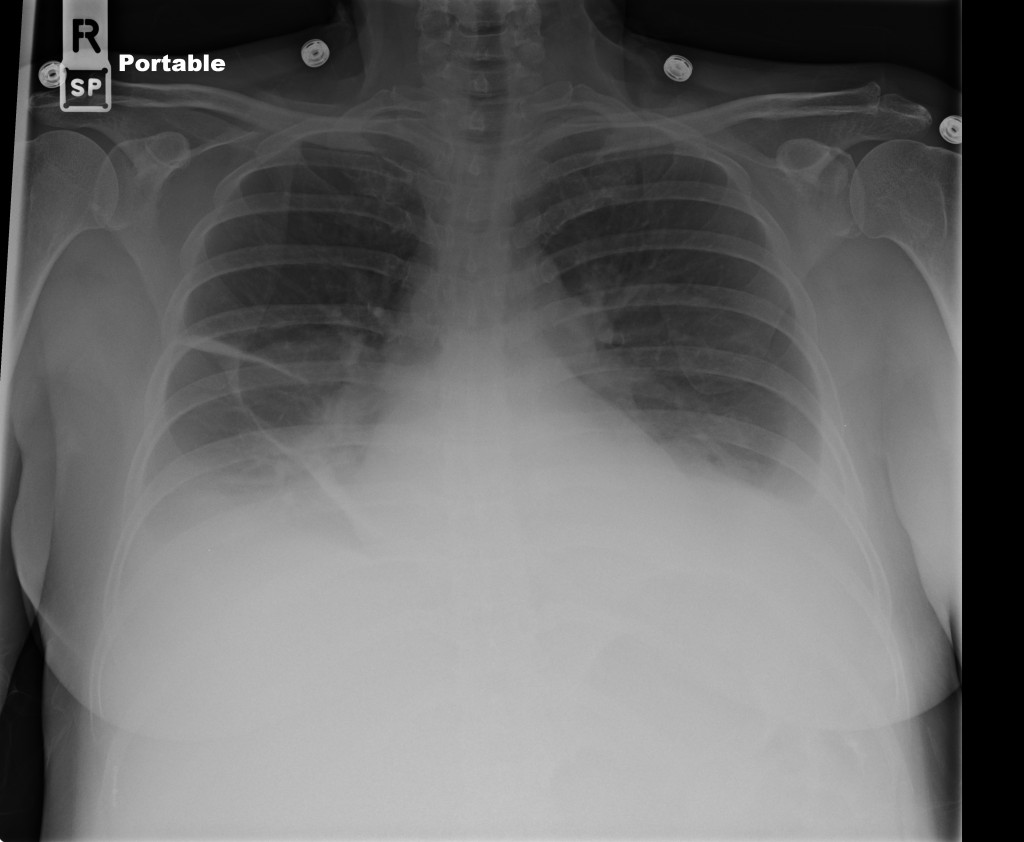 Bilateral pleural effusions with pleural fluid tracking along the minor fissure.