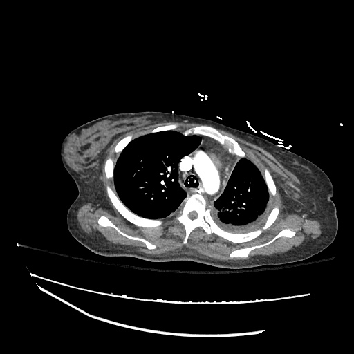 Pleural Effusion, Pulmonary Embolism