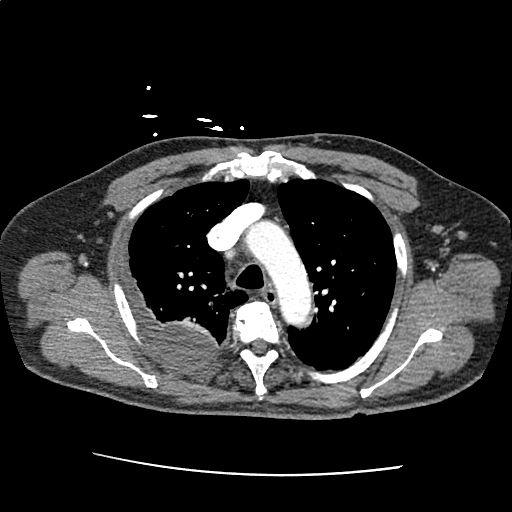 https://rxharun.com/Pleural Effusion, Pulmonary Embolism