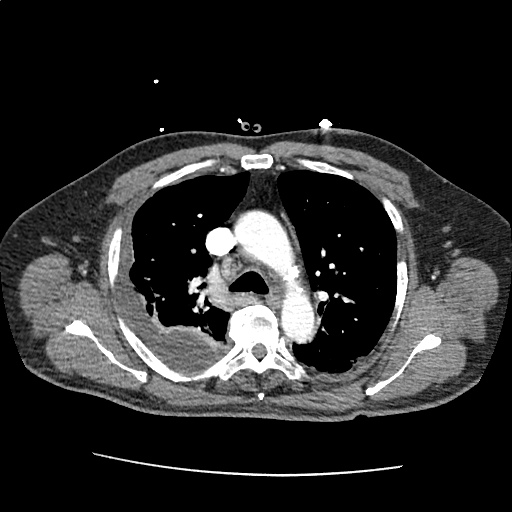 Differential Diagnosis of Pleural Effusion