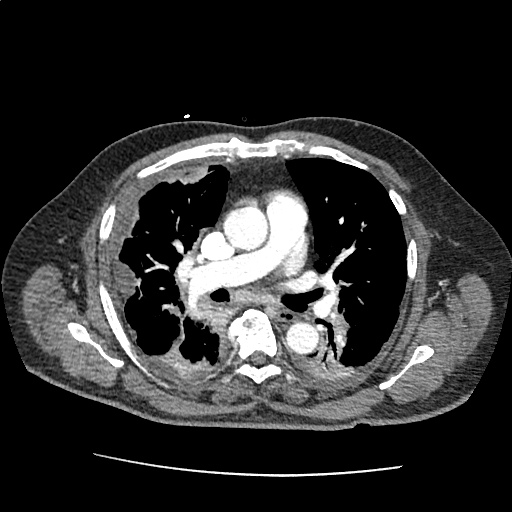 Differential Diagnosis of Pleural Effusion