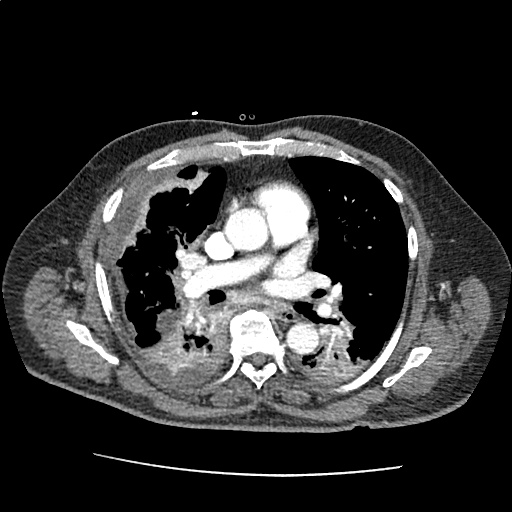 Differential Diagnosis of Pleural Effusion