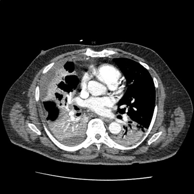 pna_11 - Differential Diagnosis of